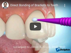 Direct Bonding of Brackets to Teeth