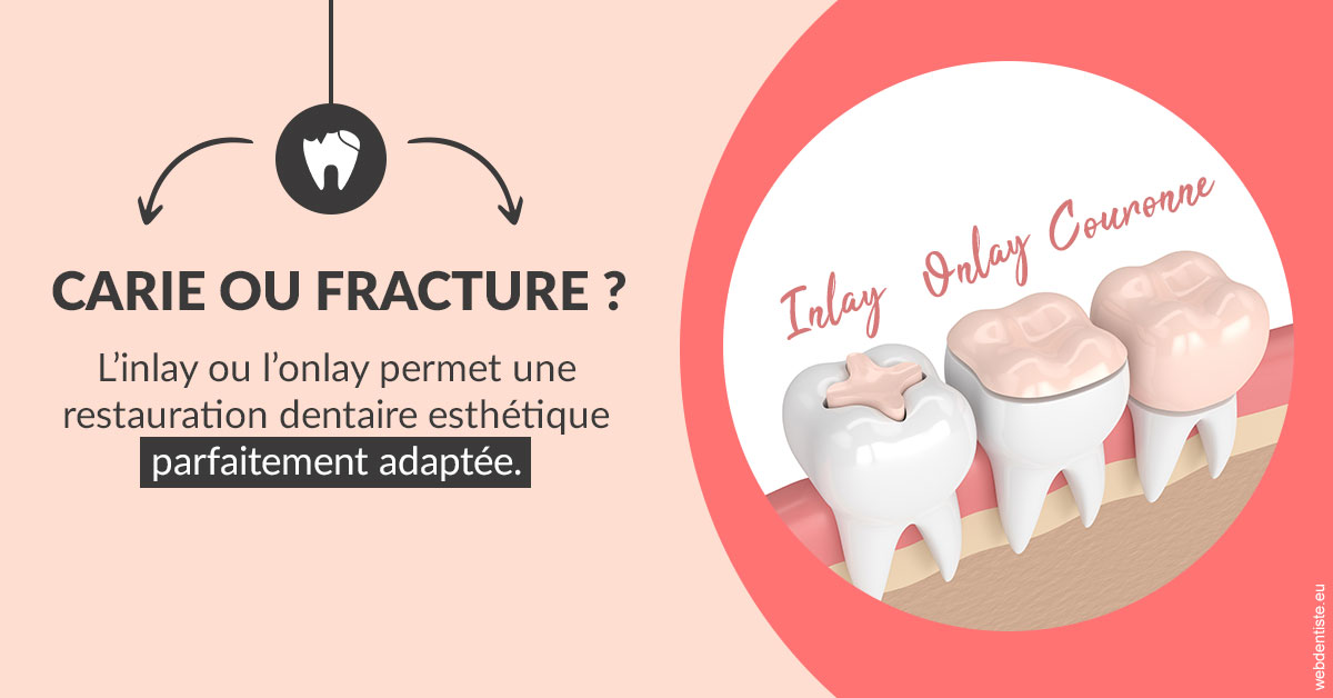 https://dr-lecarboulec-yann.chirurgiens-dentistes.fr/T2 2023 - Carie ou fracture 2