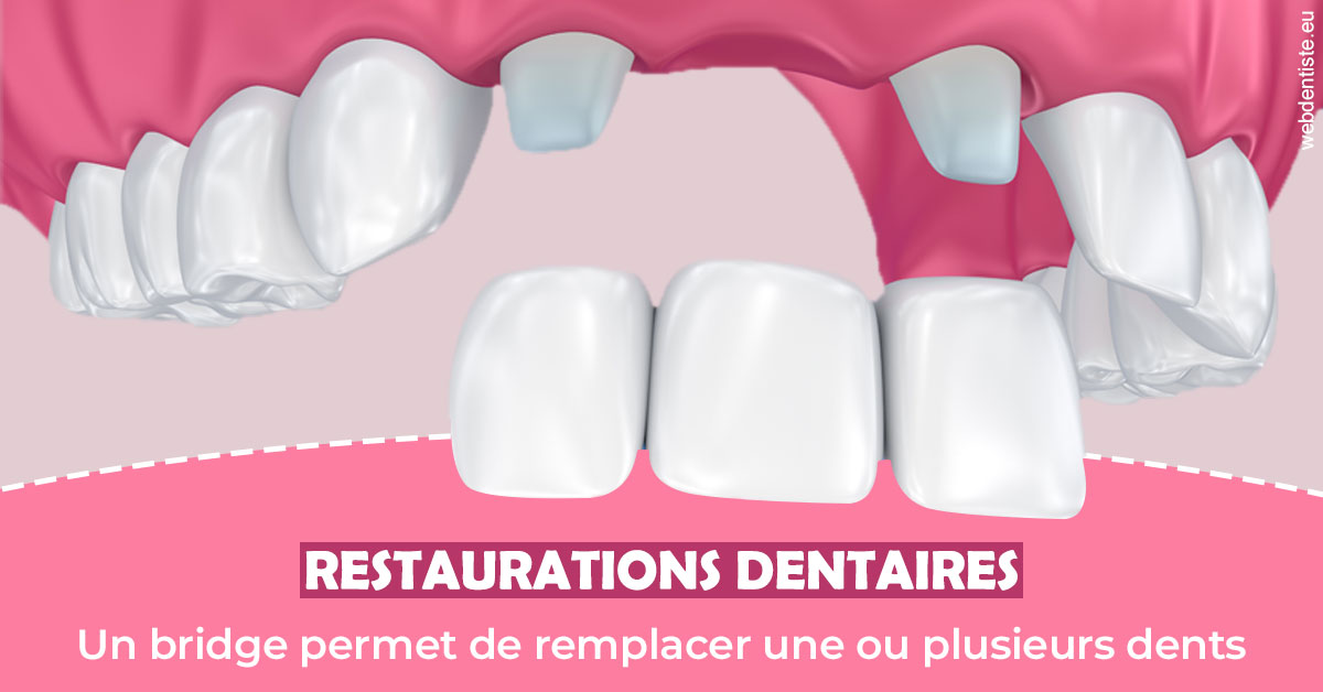 https://dr-lecarboulec-yann.chirurgiens-dentistes.fr/Bridge remplacer dents 2
