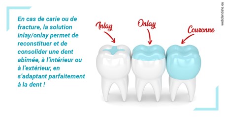 https://dr-lecarboulec-yann.chirurgiens-dentistes.fr/L'INLAY ou l'ONLAY
