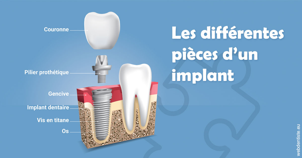 https://dr-lecarboulec-yann.chirurgiens-dentistes.fr/Les différentes pièces d’un implant 1