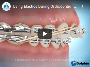 Using Elastics During Orthodontic Treatment - Overjet