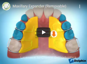 Maxillary Expander (Removable)
